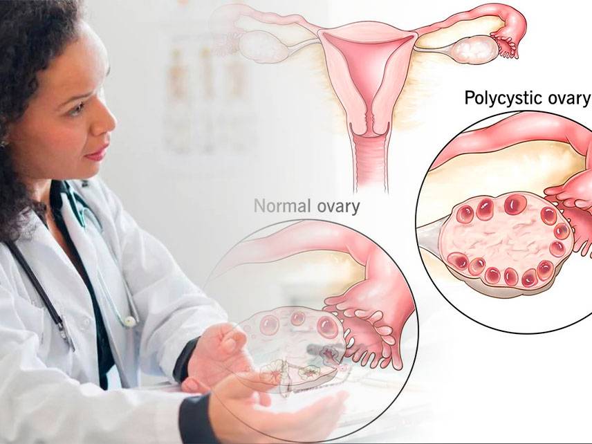 Is polycystic ovary syndrome serious?