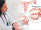 ¿Es grave el síndrome de ovario poliquístico?