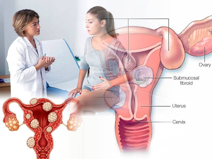 What is the main cause of uterine fibroids?